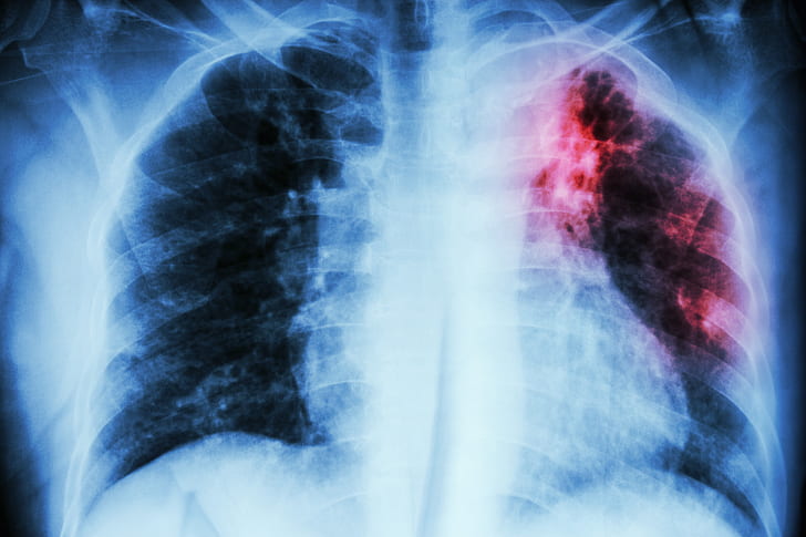 leke, hastalık, akciğerler, radyografi, enfeksiyon, HD masaüstü duvar kağıdı