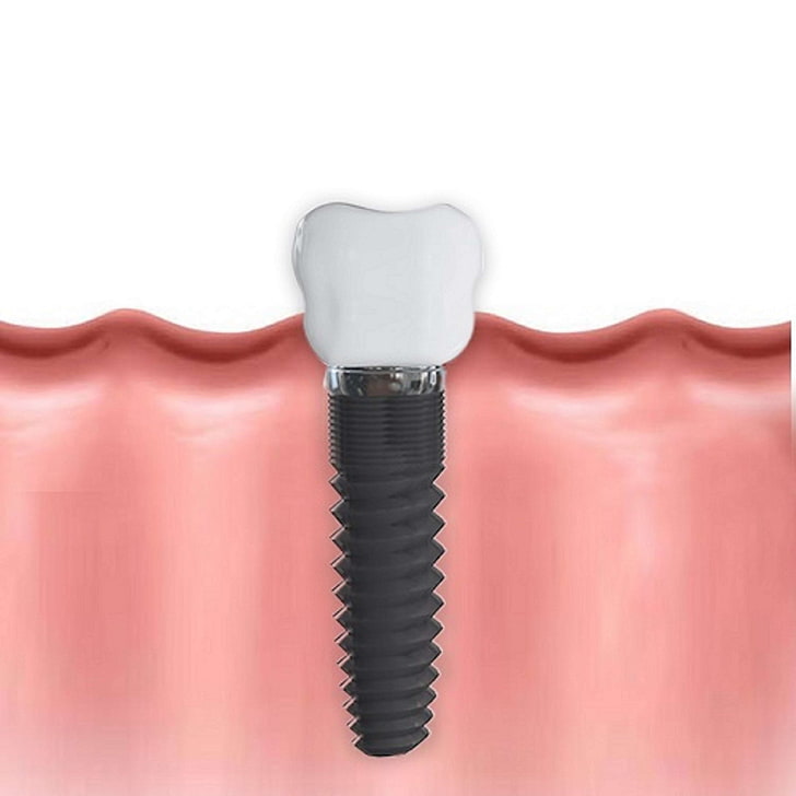 dentysta, implanty dentystyczne, dentysta, stomatologia, zdrowie, zęby, ząb, Tapety HD