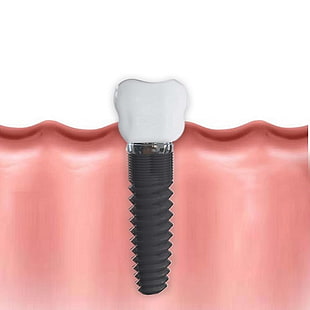 dental, implantes dentários, dentista, odontologia, saúde, dentes, dente, HD papel de parede HD wallpaper