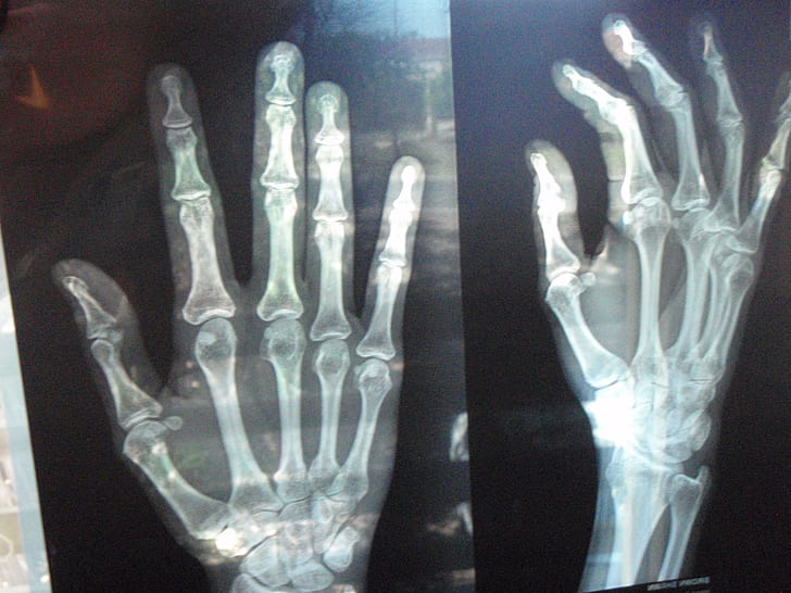 Рентгенова снимка, рентгенова снимка, анатомия, ръка, лекар, фотография, кости, HD тапет